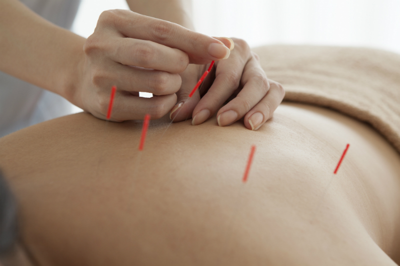 3 Important Facts About Acupuncture That Everyone Should Know