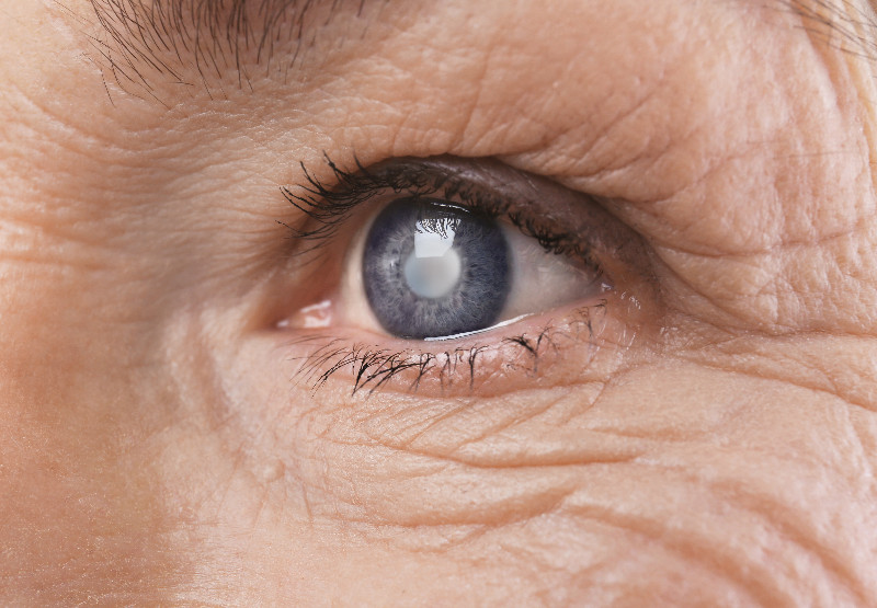 What You Need to Know About Eyelid Surgery and Where to Get It in Wichita, KS