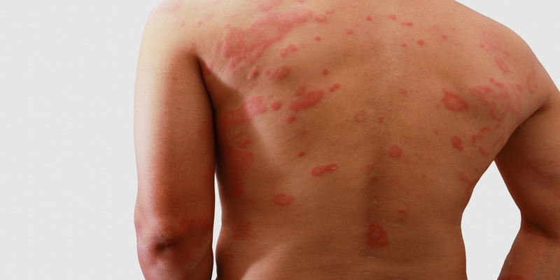 Shingular Spray for Pain Relief and Skin Renewal When Shingles Strikes